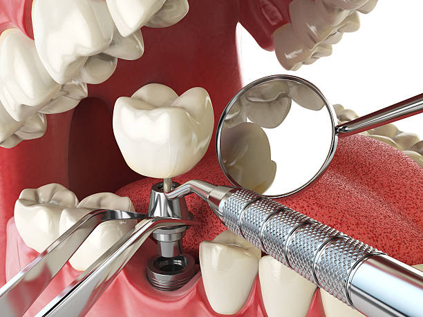 Best Dental Abscess Treatment in Covington, VA